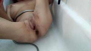 Lizzy Yum - Lizzy Yum Post Op cunt And Verification